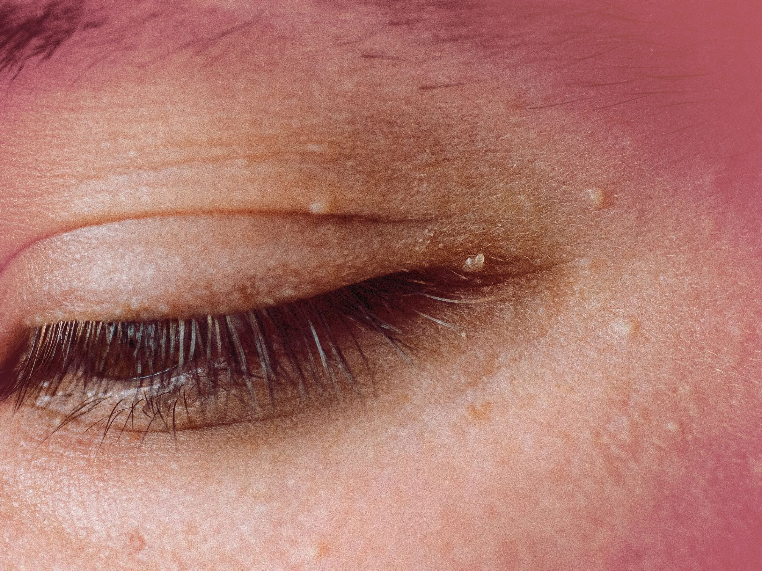 6 Types Of Eyelid Bumps And How To Treat Them According To Dermatologists Allure