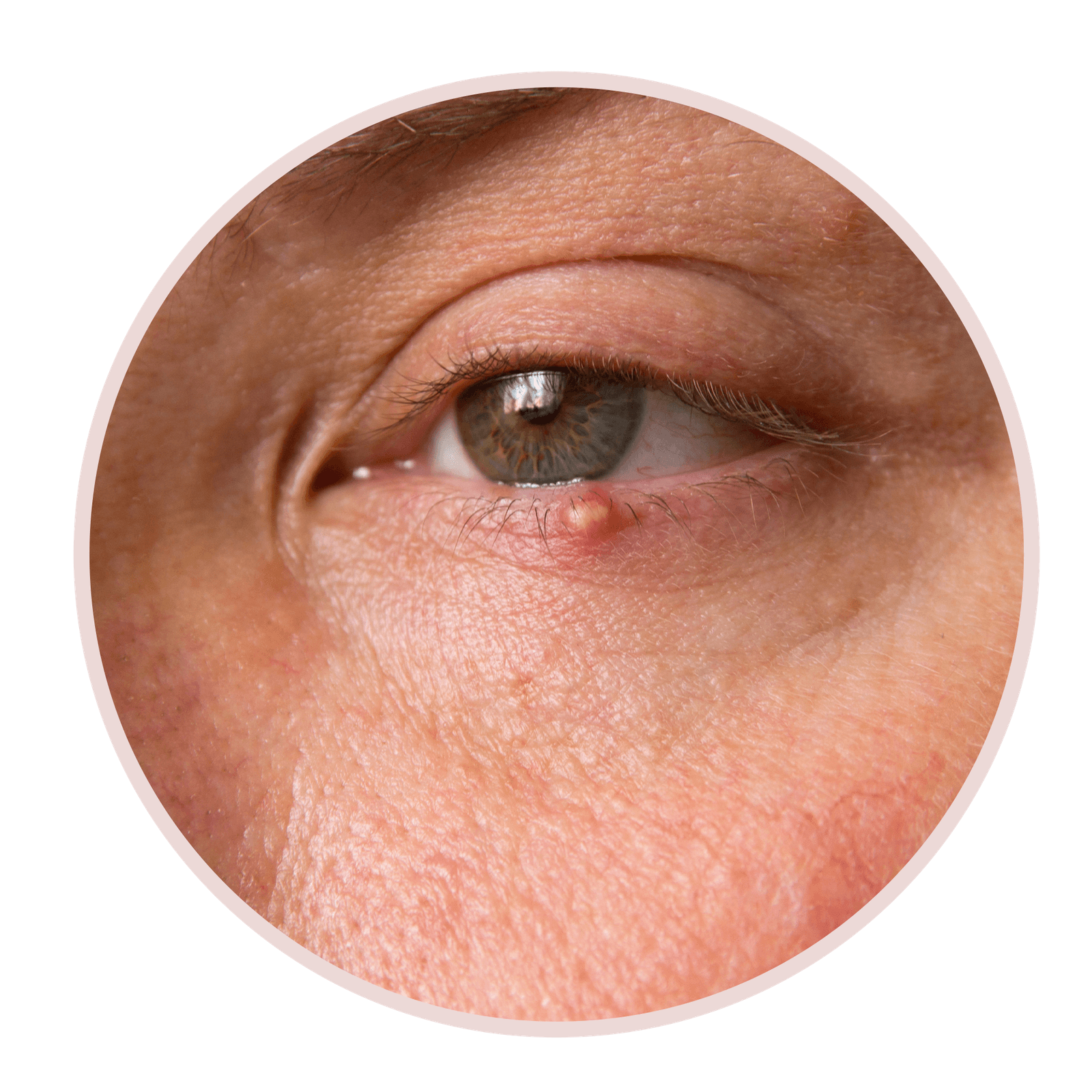 6 Types Of Eyelid Bumps And How To Treat Them According To Dermatologists Allure