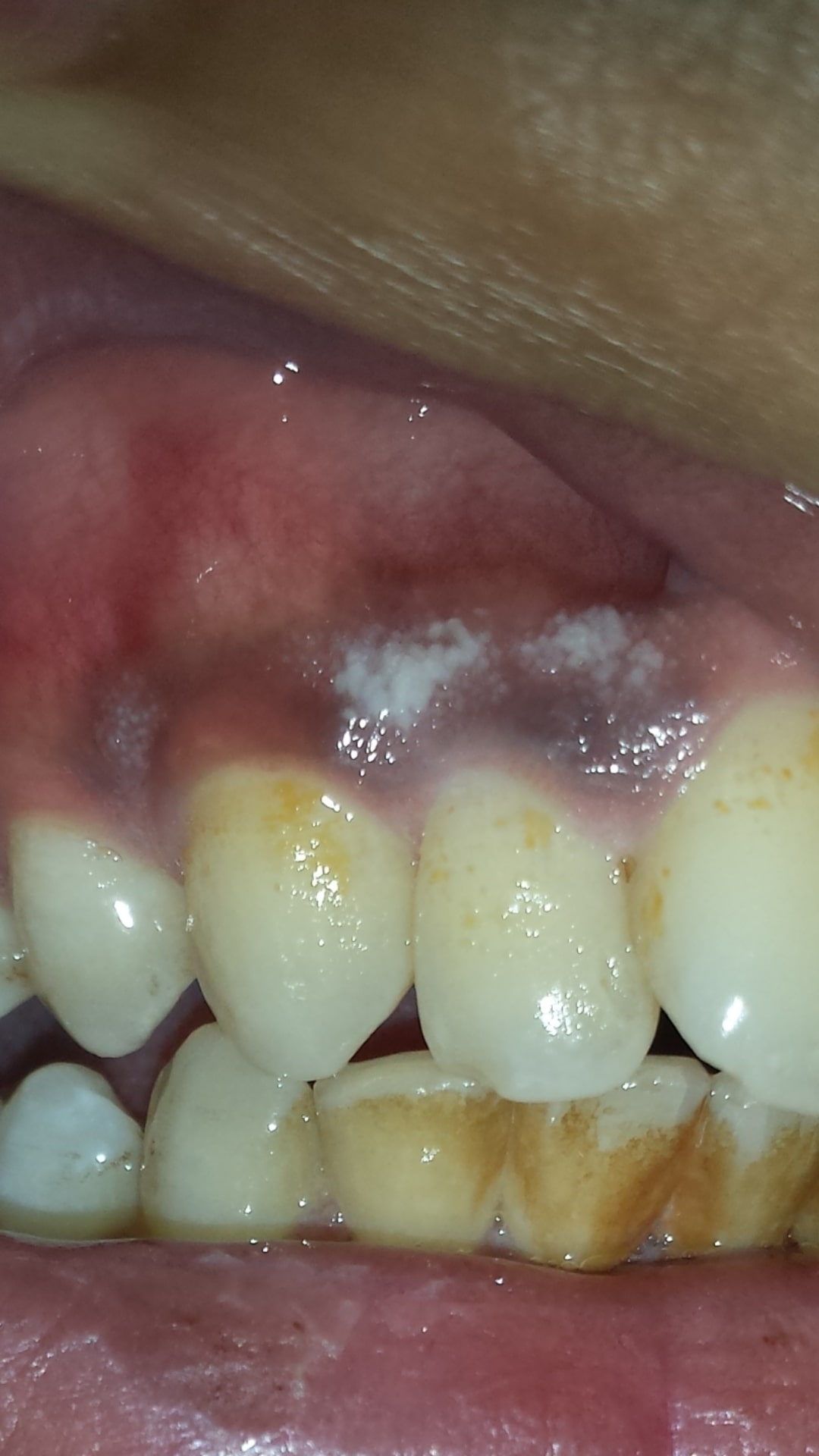 Ask A Dentist Online For White Spots On Gums