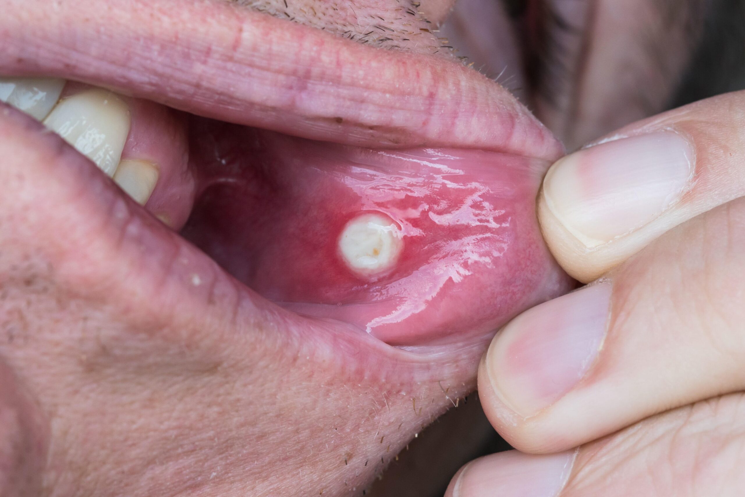 Bump In Gums Causes And How To Treat Them