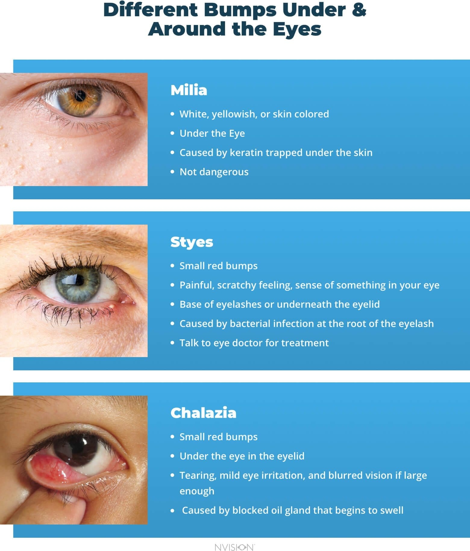 Bumps Under The Eyes Types U0026 How To Treat Them NVISION