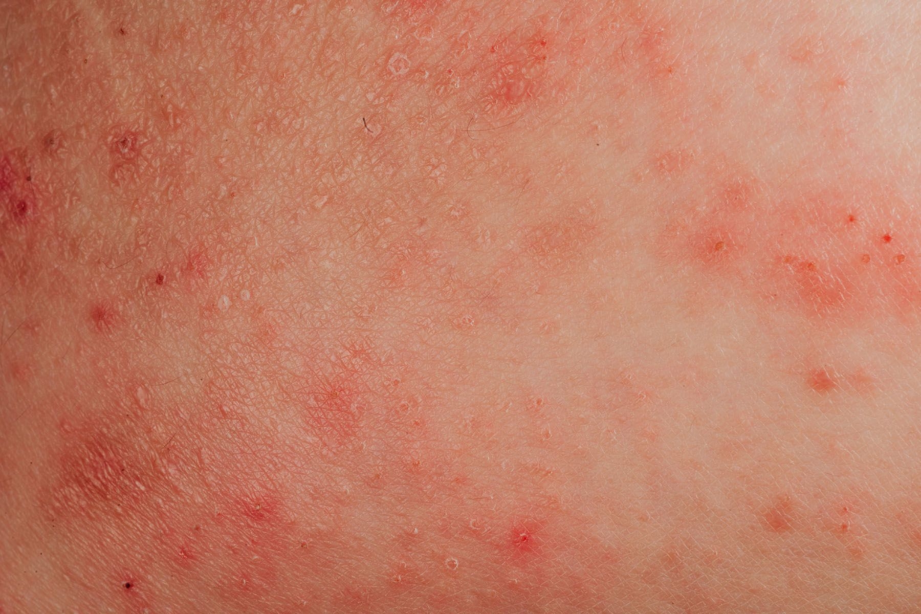 Common Rashes Types Symptoms Treatments U0026 More