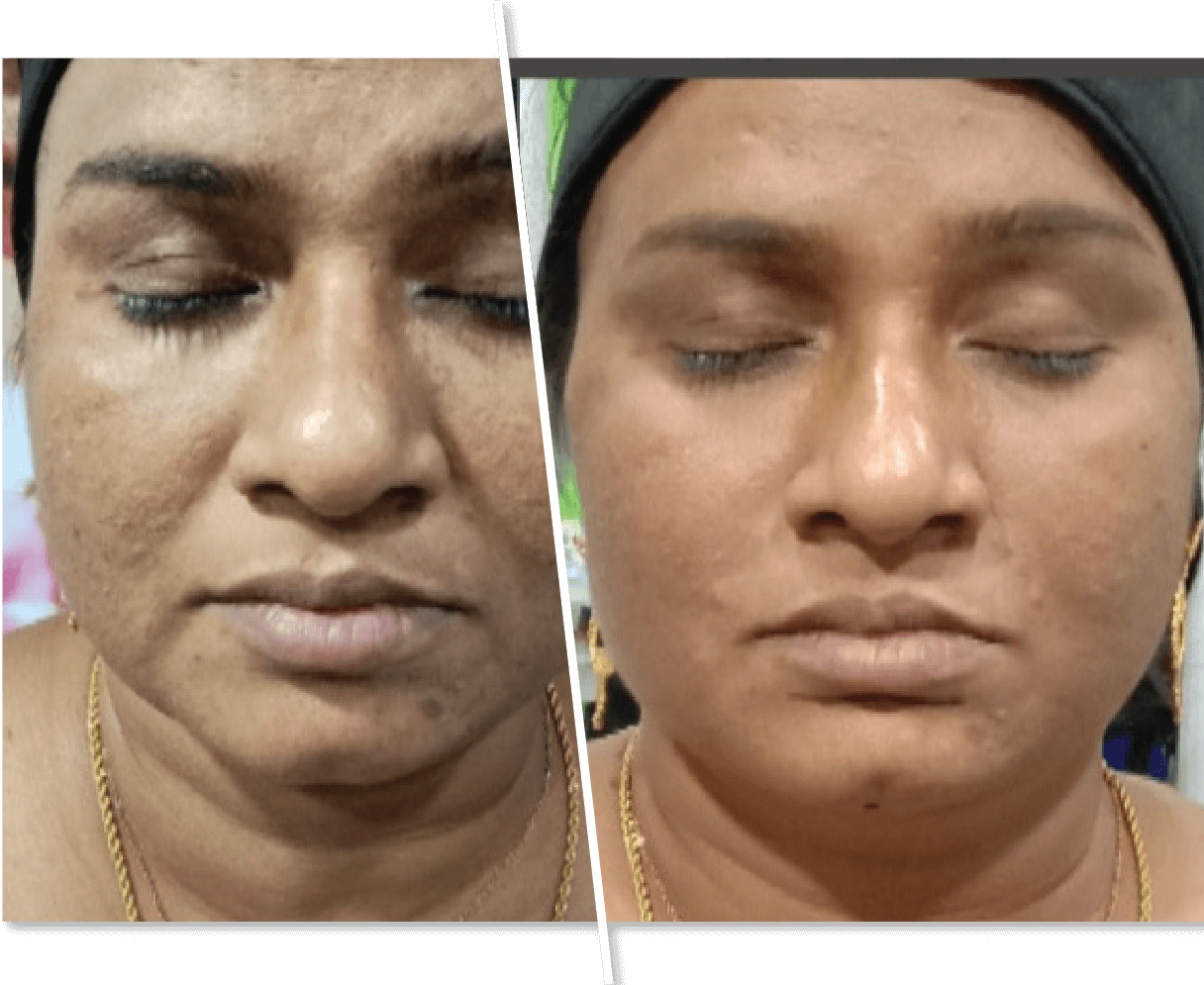 black dots on face removal