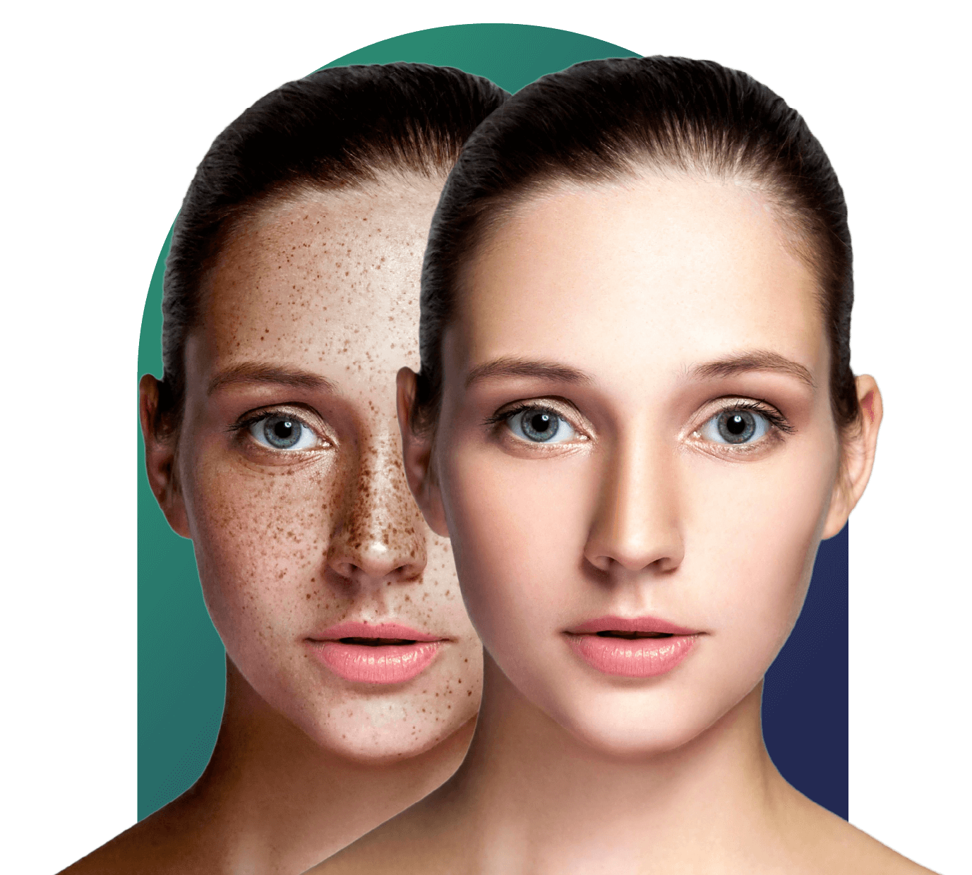 Dark Spot U0026 Marks Removal Treatment For Face And Skin