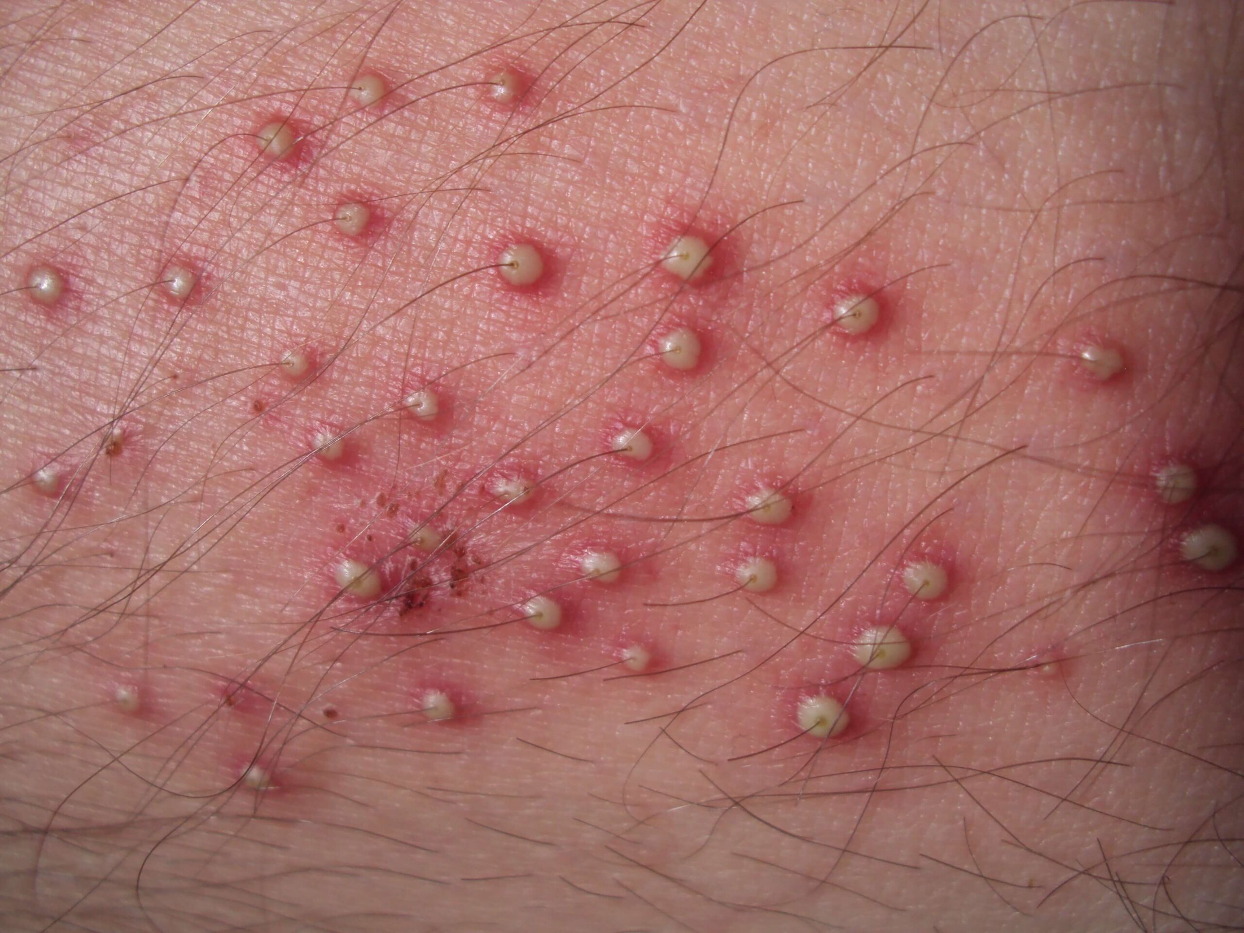 Identifying 21 Common Red Spots On Skin Universal Dermatology