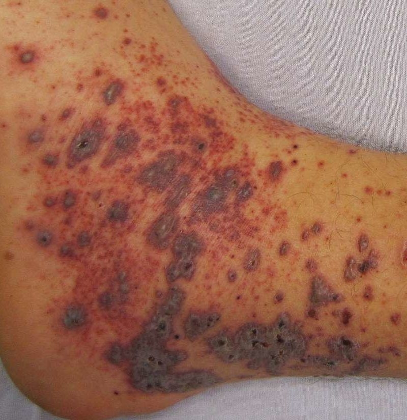 small purple dots on skin