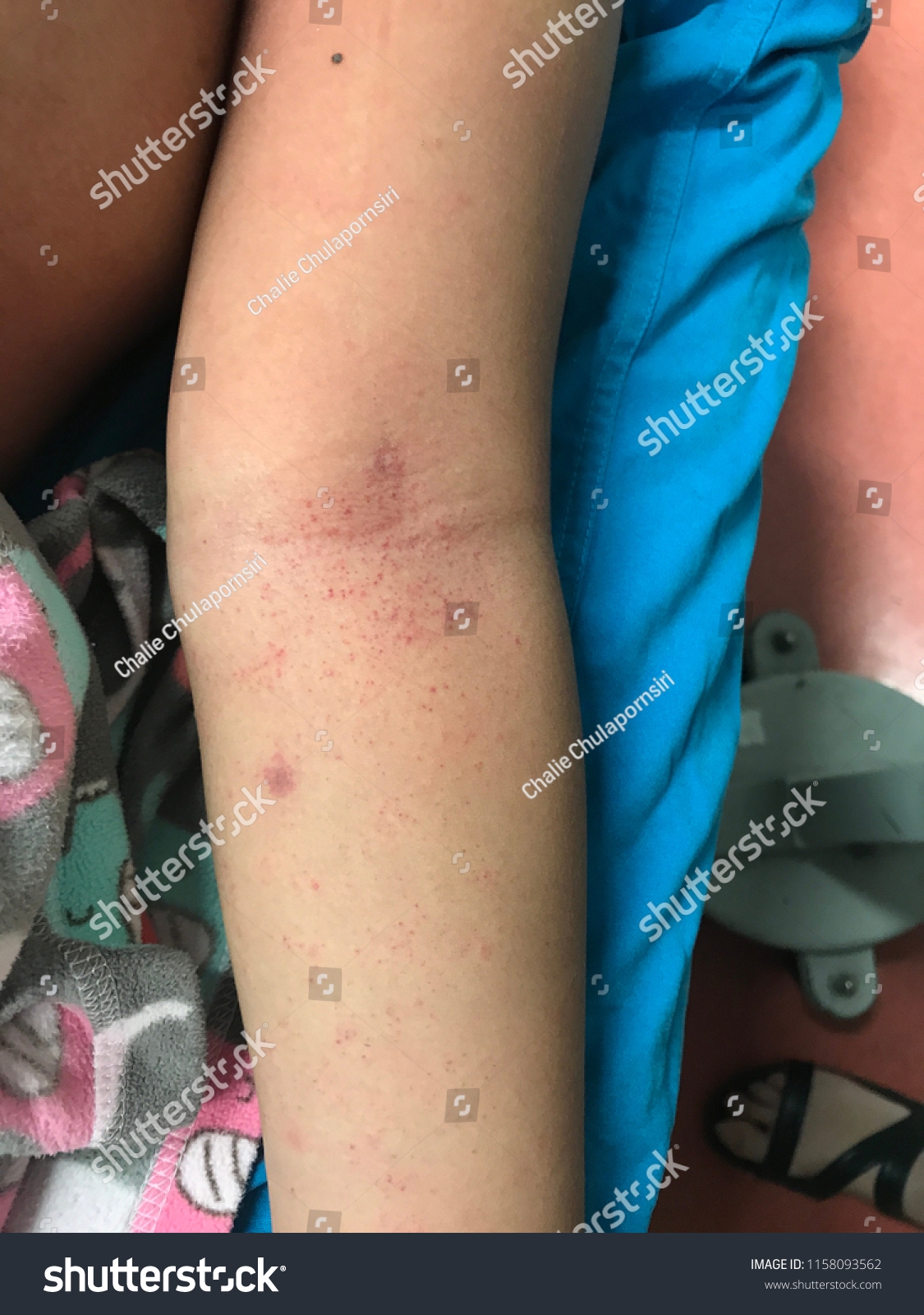 Petechiae Petechiae Tiny Purple Red Brown Stock Photo 1158093562 Shutterstock