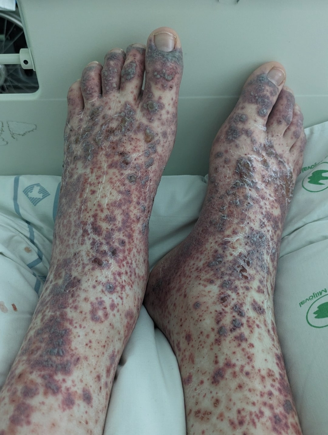 Purpura Wikipedia