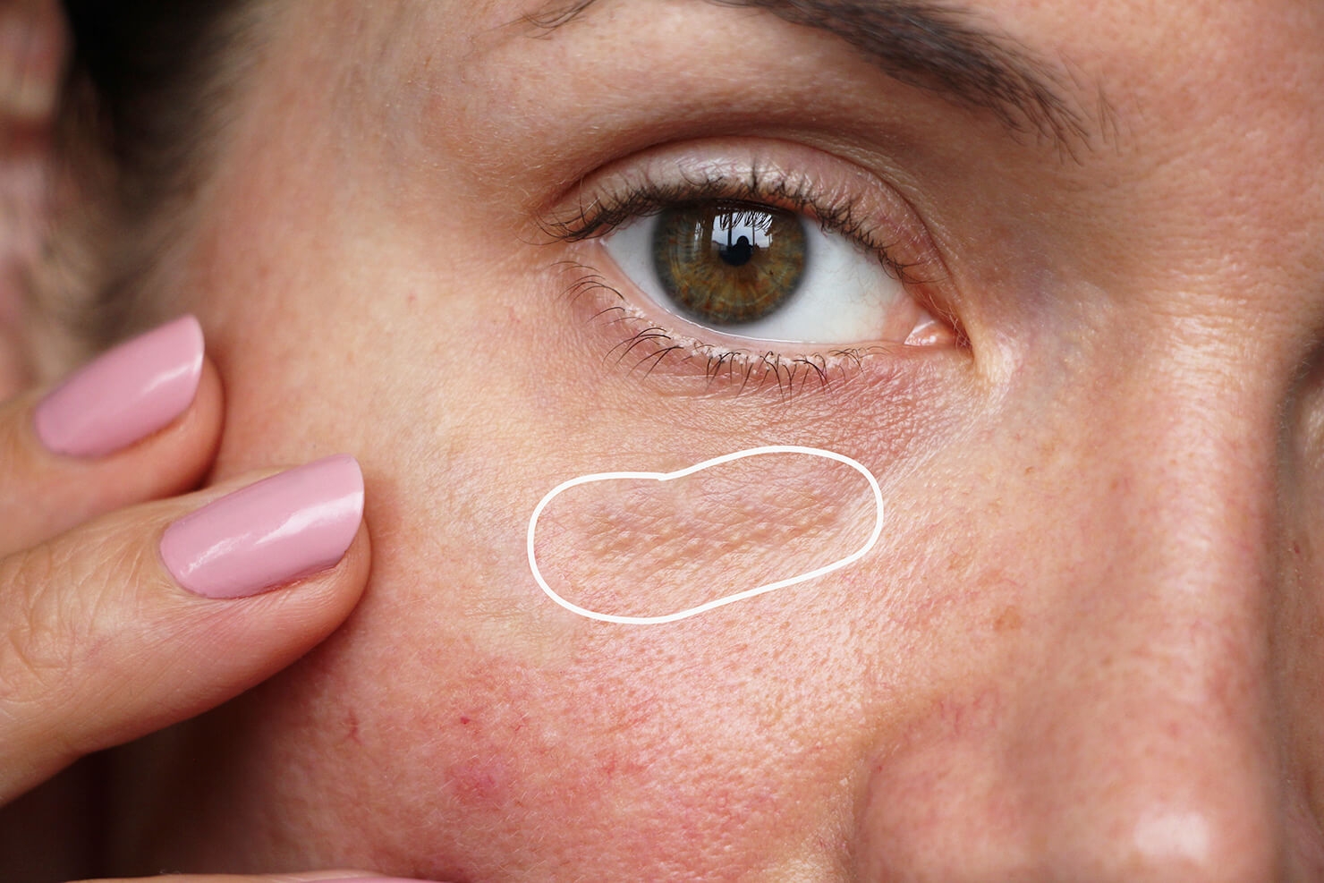 Surrey Adult Milia Under Eye Treatment Remove Milia Milk Spots Vancouver Delta White Rock