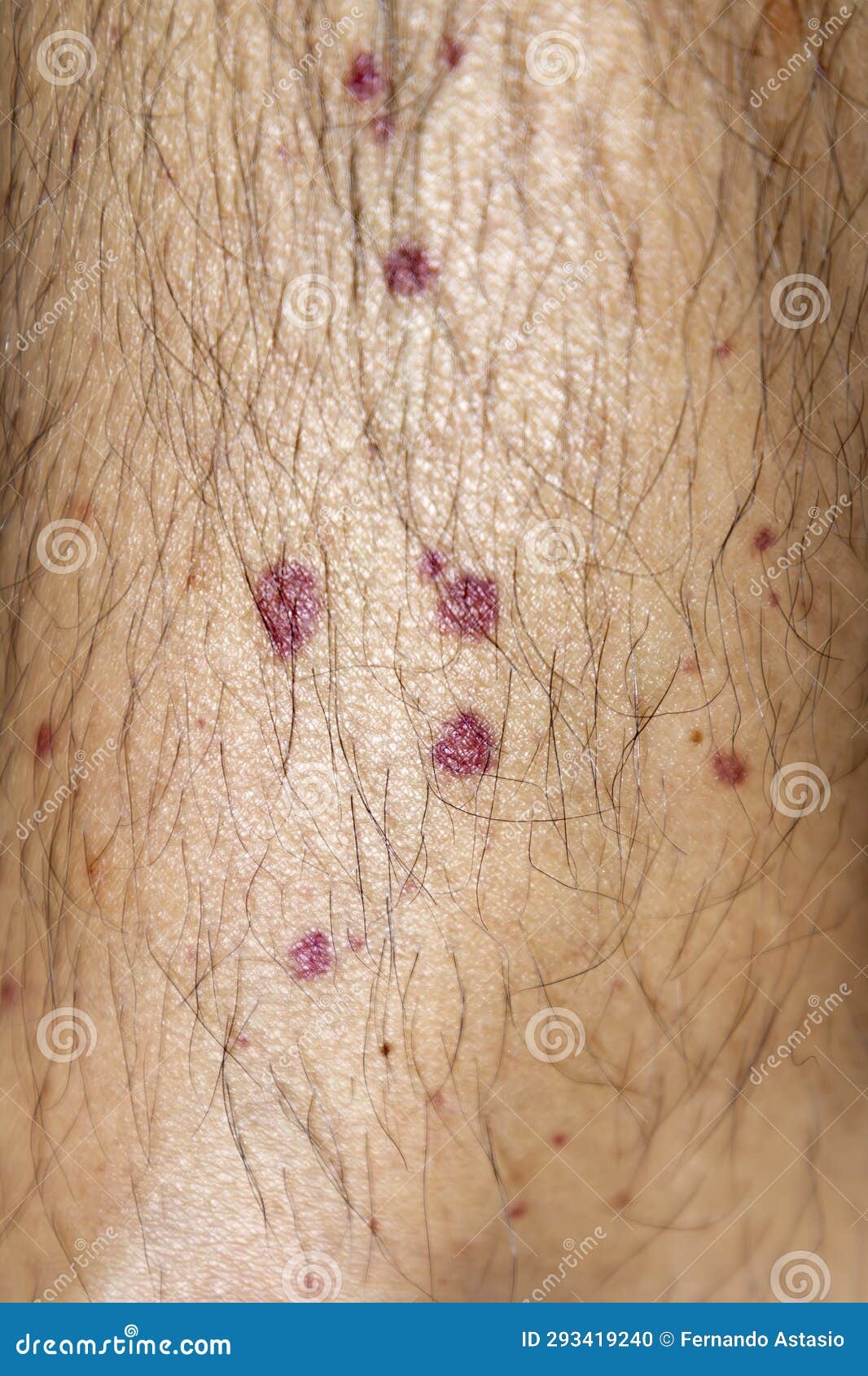 Vasculitis Vasculitis In Legs Small Red Or Purple Spots Rare Disease Stock Photo Image Of Test Hospital 293419240