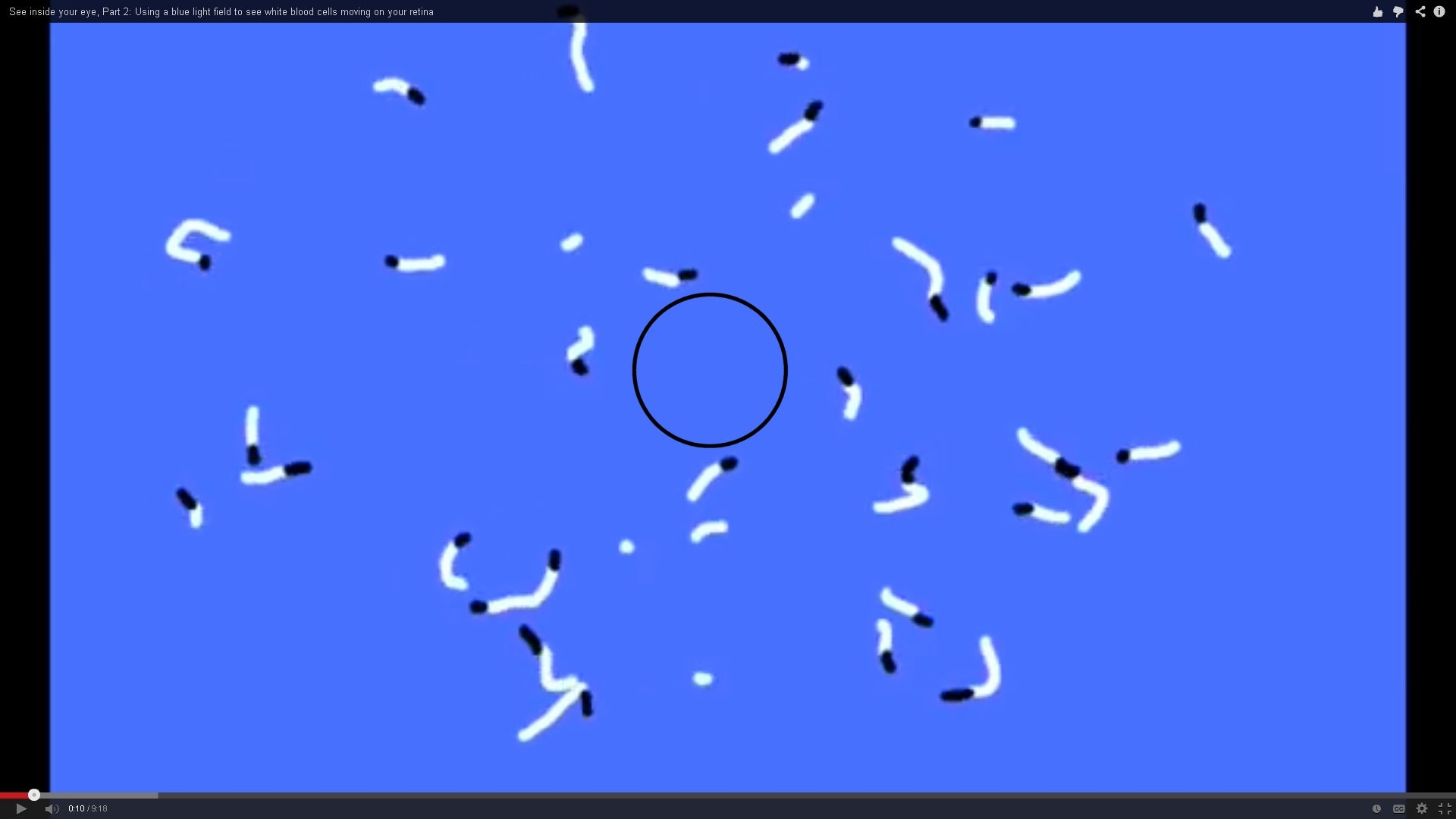 Visual Snow snowy Vision A Disease Resulting From Two Different Error Mechanisms
