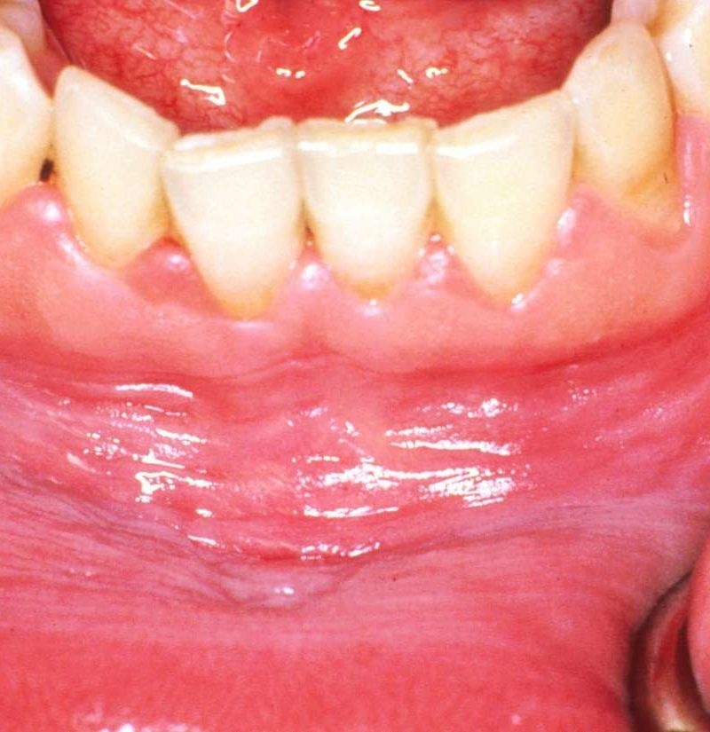 White Gums Causes Symptoms And How To Get Rid Of Them