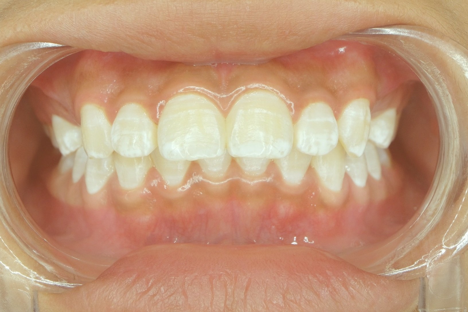 white dots on gums painful